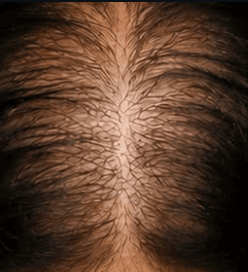 Avant la cure, vue du dessus : cheveux clairsemés, cuir chevelu visible sur tout le sommet du crâne