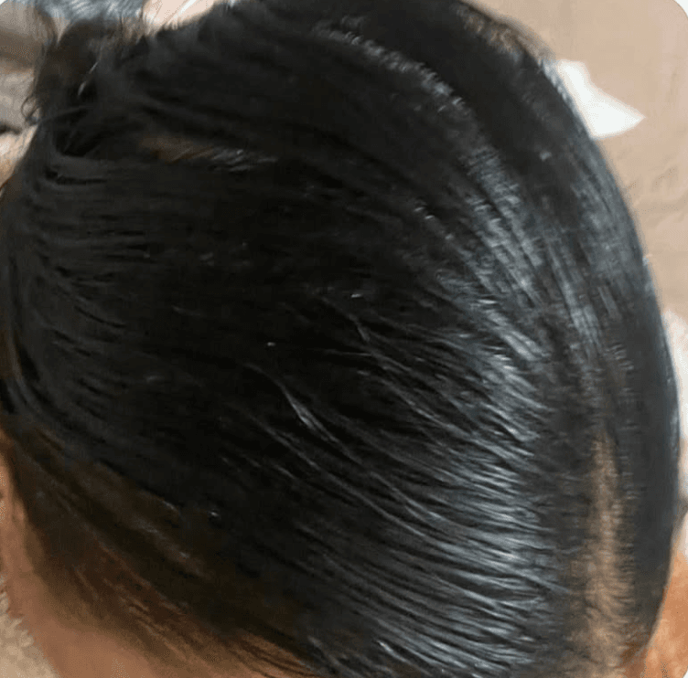 Après six mois de cure : dessus du crâne couvert, cheveux épais coiffés en arrière